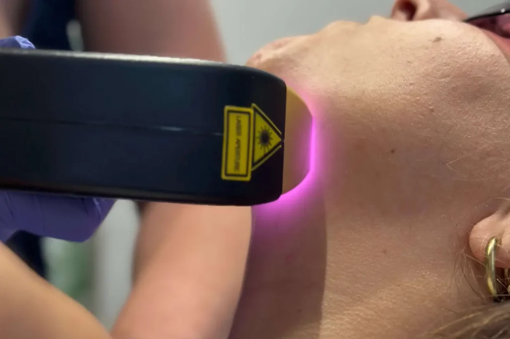 laser hair removal south london